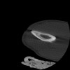 SPORK, NICO - 22.03.1976 - 02.08.2022 - CT obere Extremität - 17:51:17